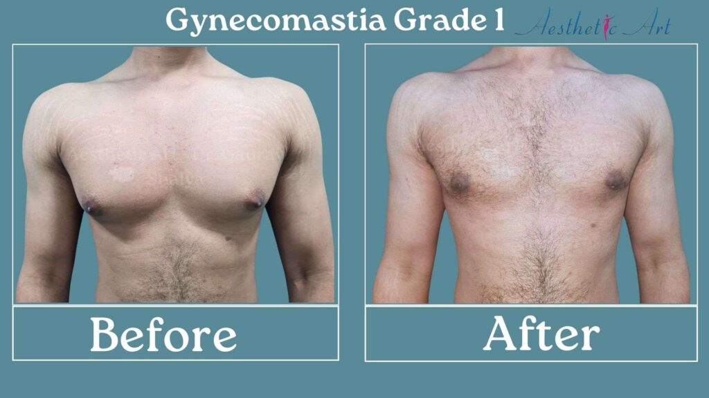 Grade 1 Gynecomastia