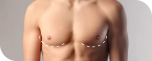 Grade 1 Gynecomastia