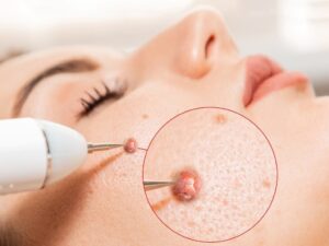 DIY Skin Tag Removal