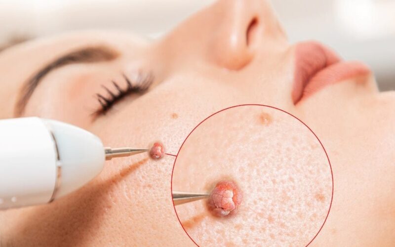 DIY Skin Tag Removal