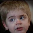 Sanfilippo Syndrome Eyebrows