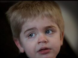 Sanfilippo Syndrome Eyebrows