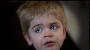 Sanfilippo Syndrome Eyebrows