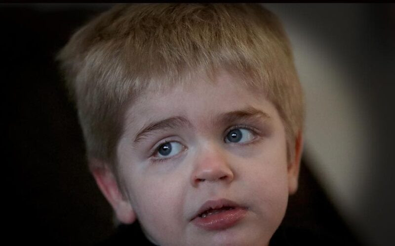 Sanfilippo Syndrome Eyebrows